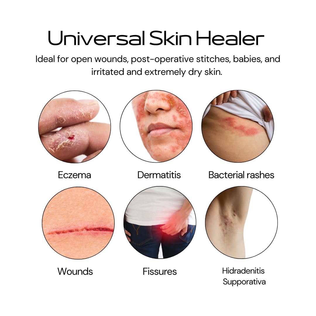 Universal Skin Healer Essential Oil Free Formula | Eczema | Hidradenitis Suppurativa | Irritated & Dry Skin | Wound Healing | Post Operative Stitches | Dermatitis | Pilonidal cyst | Anal Fissures